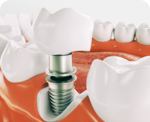 Имплантология (имплантация зубов)