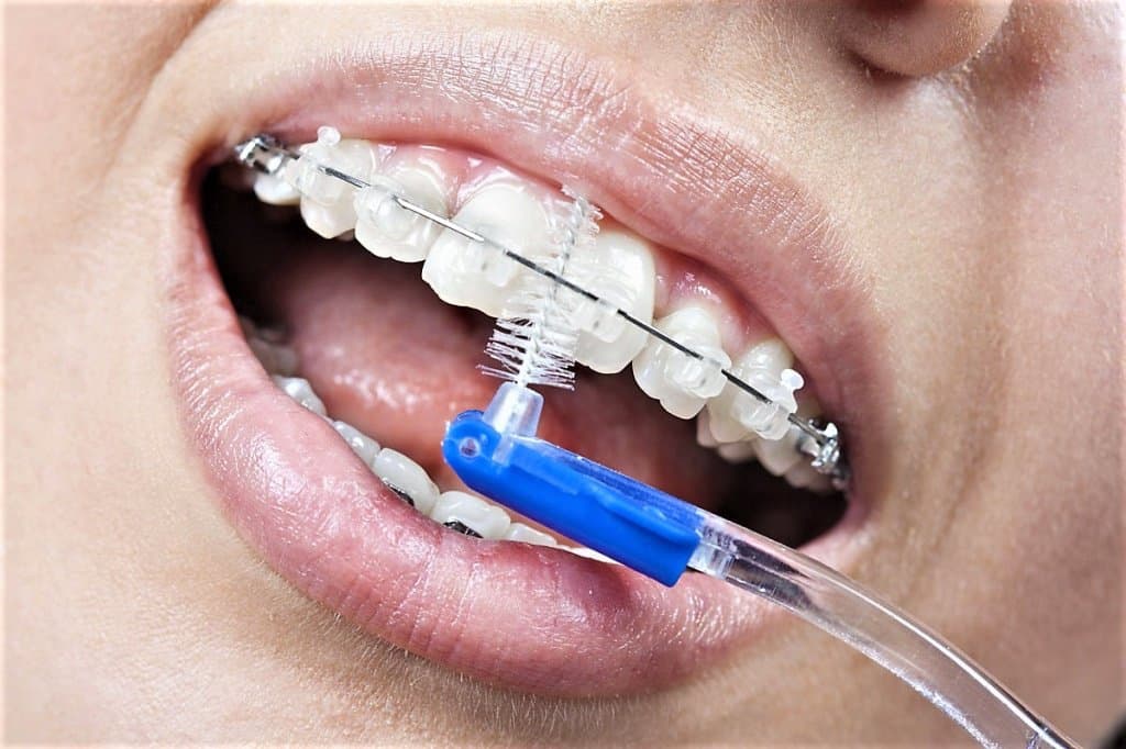 можно ли электрической зубной щеткой чистить брекеты