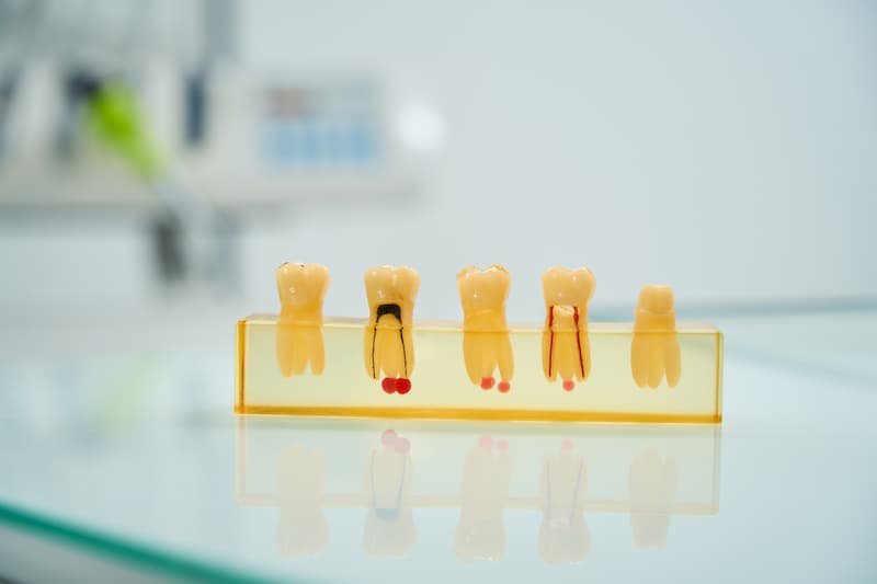 Кариес на передних зубах: методы лечения